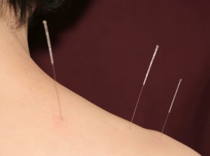 What Can Acupuncture Treat? Needle for neck pain