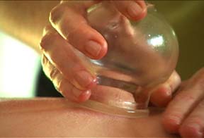 Cupping on human skin